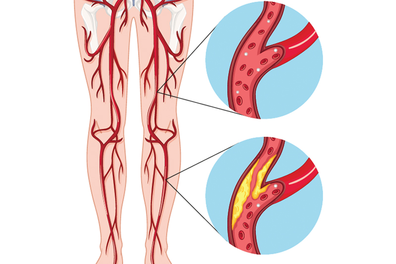 Tips if you have Peripheral Vascular Diseases and Their Treatment