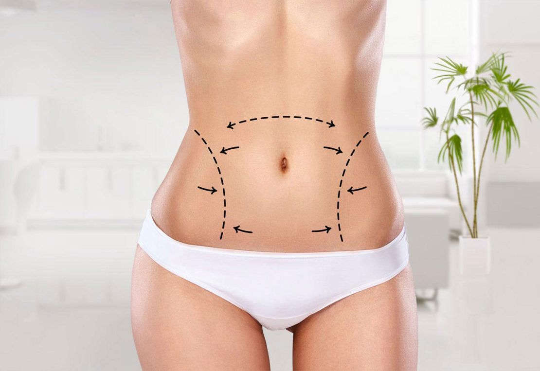 How to get the best liposuction in Istanbul to get the perfect figure 
