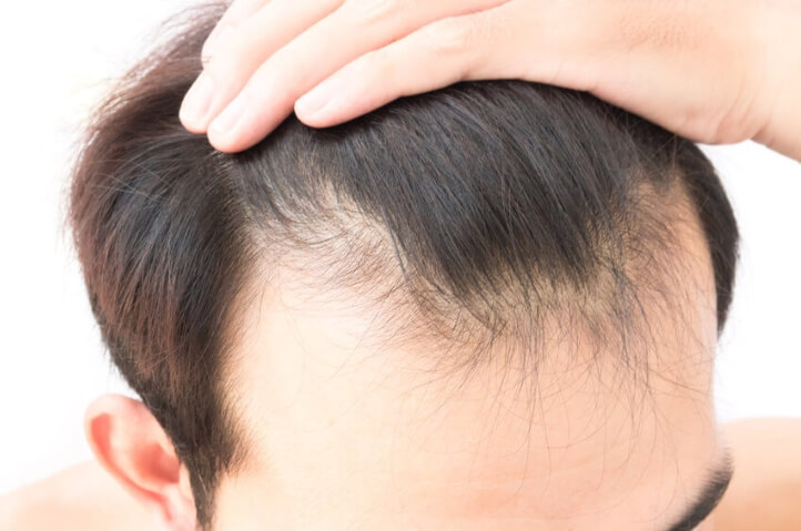 دليلك لزراعة الشعر في تركيا - العلاج والتوقعات والمخاطر