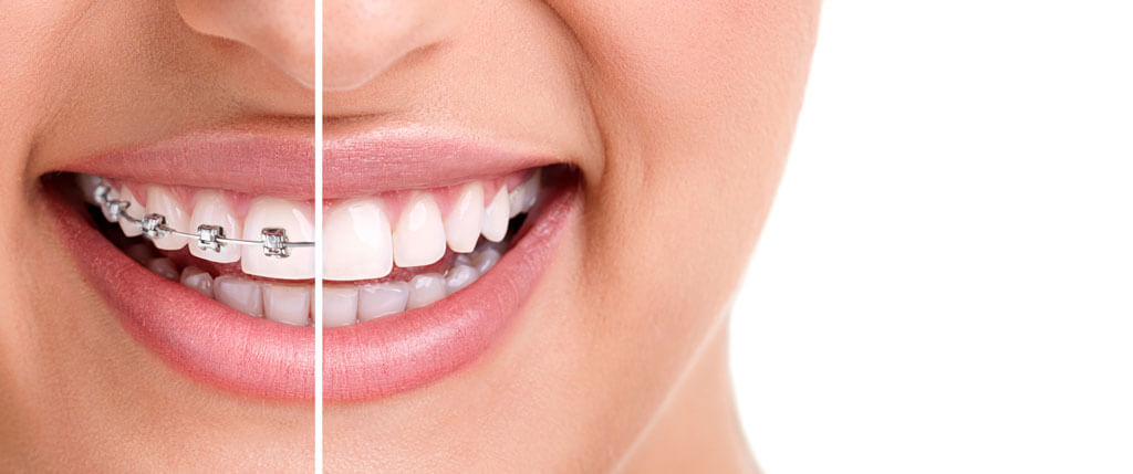 احصل على علاج الأسنان المثالي مع علاج تقويم الأسنان في تركيا